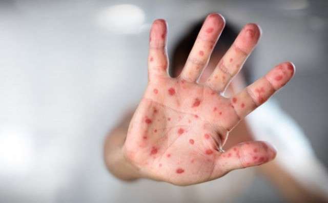 17 случаев заболевания корью подтверждены в области